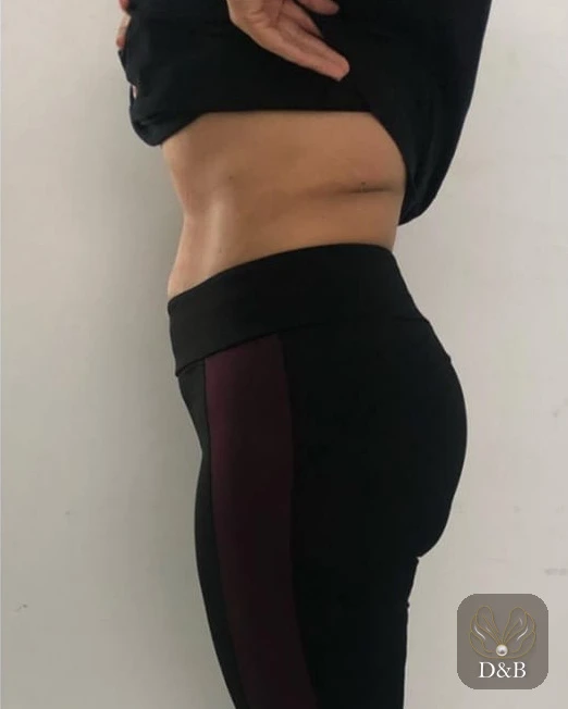 Bel ve karın yandan, bölgesel incelme öncesi ve sonrası — sonra