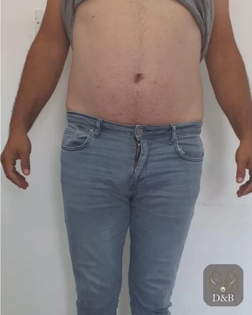 Erkek karın bölgesi önden, bölgesel incelme öncesi ve sonrası — sonra