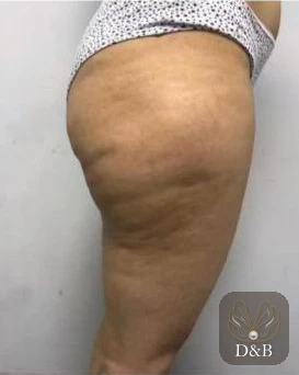 Kalça yandan, bölgesel incelme öncesi ve sonrası — önce